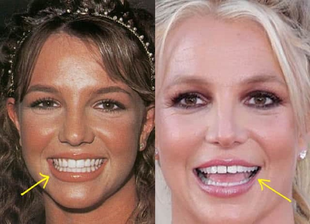 What Happened to Britney Spears Teeth? Why are they spreading apart?